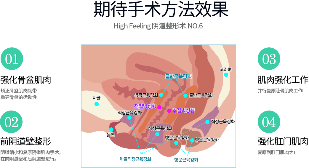 女性私密整形, 阴道整形 , 小阴唇整形 ,韩国女性整形, 韩国私密整形, 韩国江南妇产科