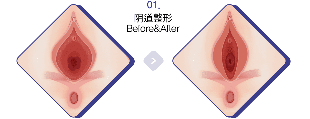 阴道整形 Before&After