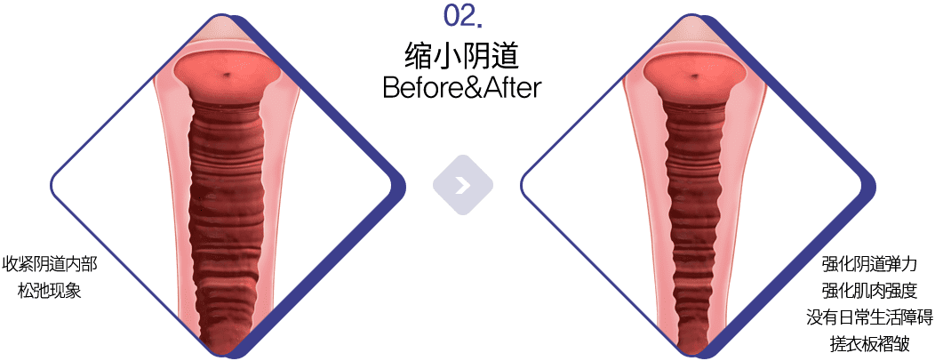 缩小阴道 Before&After 收紧阴道内部松弛现象 强化阴道弹力强化肌肉强度没有日常生活障碍搓衣板褶皱