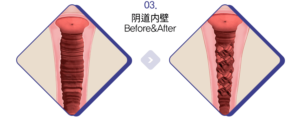 阴道内壁 Before&After