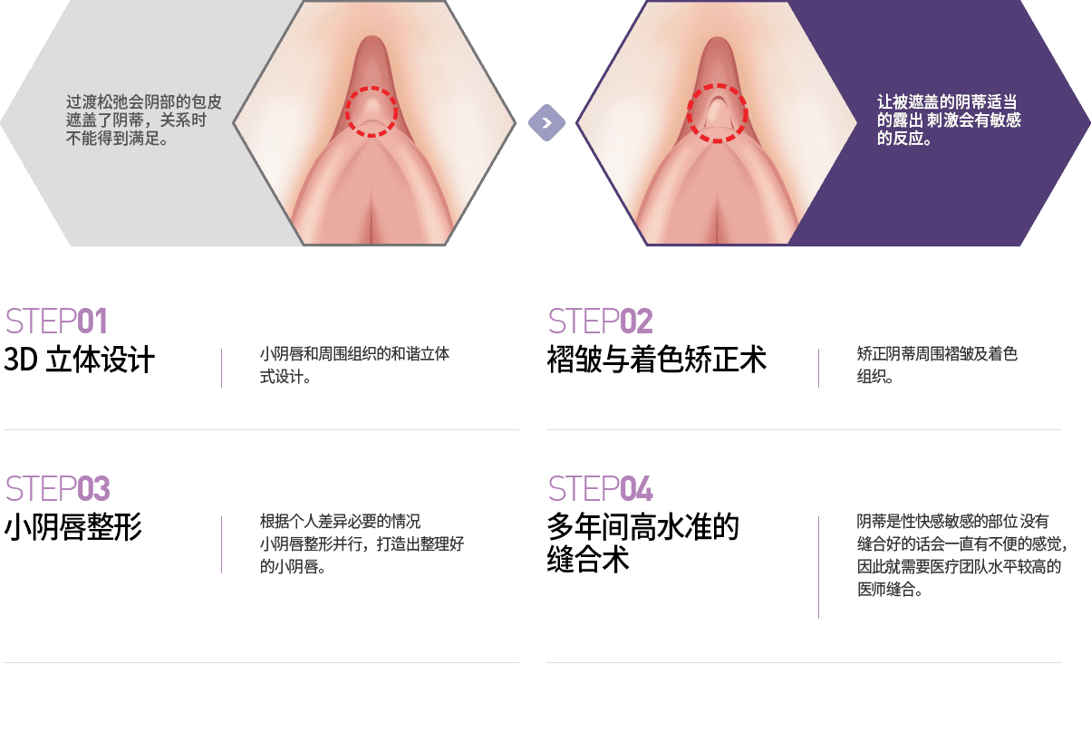 女性私密整形, 阴道整形 , 小阴唇整形 ,韩国女性整形, 韩国私密整形, 韩国江南妇产科