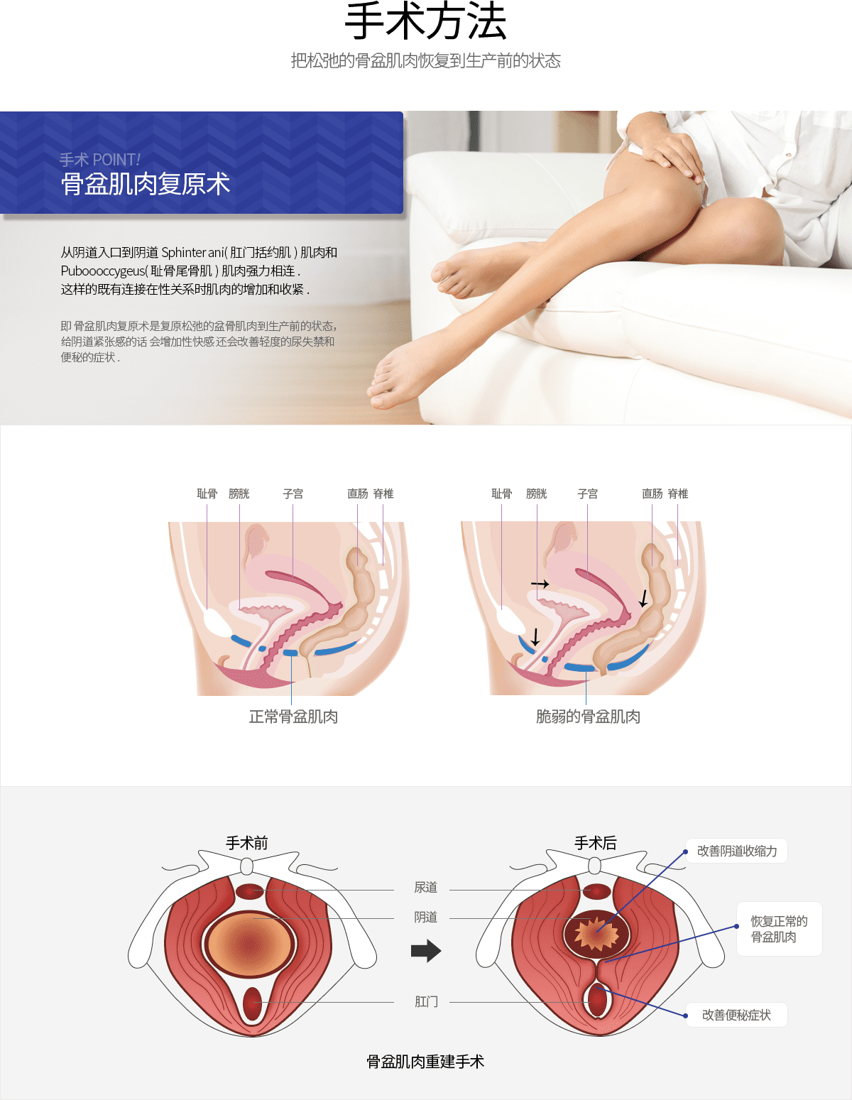 手术方法 把松弛的骨盆肌肉恢复到生产前的状态